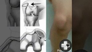 Смещение коленной чашечки