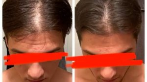 топический финастерид, топический миноксидил