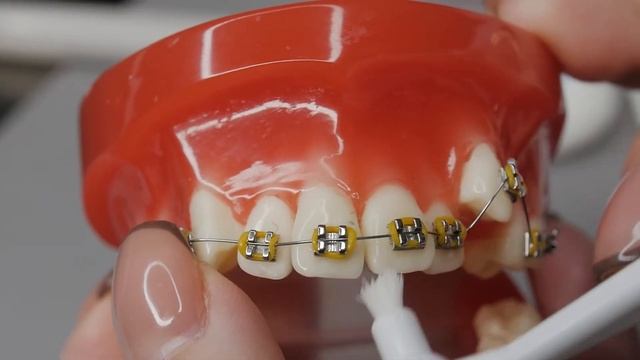 Как правильно чистить зубы с брекетами