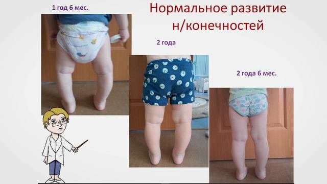 Деформация нижних конечностей