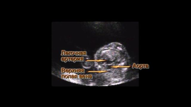9. Двойное отхождение сосудов от правого желудочка часть 3 смотреть онлайн