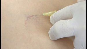 Компрессионная микросклеротерапия-(480p25).webm