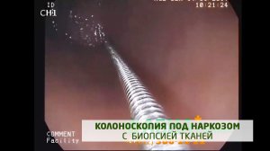 Колоноскопия под наркозом с биопсией ткани на анализ