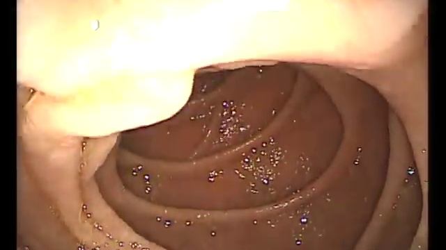 Эрозивный гастрит Острые язвы желудка Гастроскопия в Мариуполе смотреть онлайн