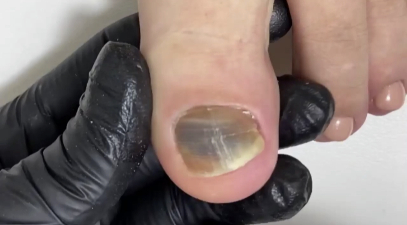 Онихомадезис смотреть онлайн