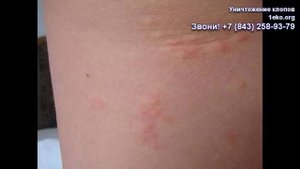 Укусы постельных клопов на людях и детях