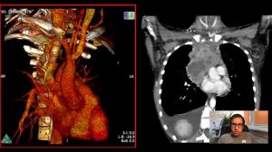 CT и FDG PET/CT при первичной медиастинальной лимфоме (PMBCL)