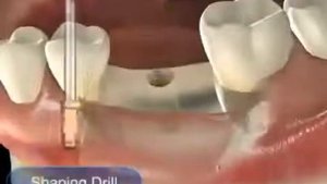 ИМПЛАНТ OSSTEM SSIII