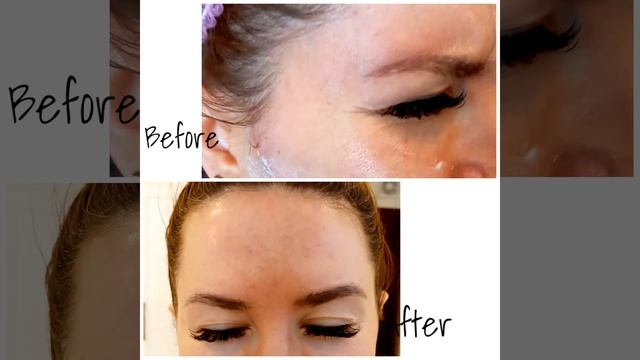 Ботулинотерапия #Botox #Danang #Dalat #Vietnam @NEO_GEO_BEAUTY