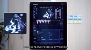 Технология  Smart VTI на ультразвуковом аппарате ТЕ7 - демо видео