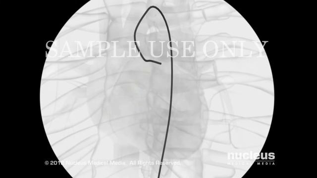 Angioplastía coronaria смотреть онлайн