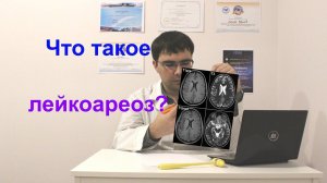Лейкоареоз головного мозга: что это такое?