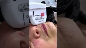 СМАС-лифтинг на аппарате Ютимс.