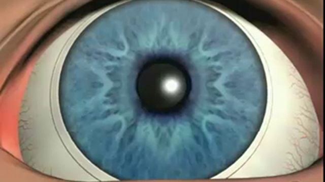 Неоваскуляризация роговицы смотреть онлайн