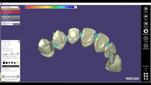 EXOCAD 2020 Tutorial - Preview - Gefräste Lager und Interlocs für Geschiebe -Freestyle