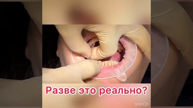 Невероятно красивые зубы #зубы #стоматологиямосква #имплантациязубов