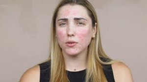 ВСЕ О ГИАЛУРОНОВОЙ КИСЛОТЕ / ГИАЛУРОНОВАЯ КИСЛОТА ПРОТИВ ШРАМОВ