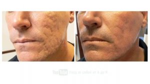 КАК ИЗБАВИТЬСЯ ОТ ШРАМОВ И РУБЦОВ ПОСЛЕ АКНЕ☝️????♂️