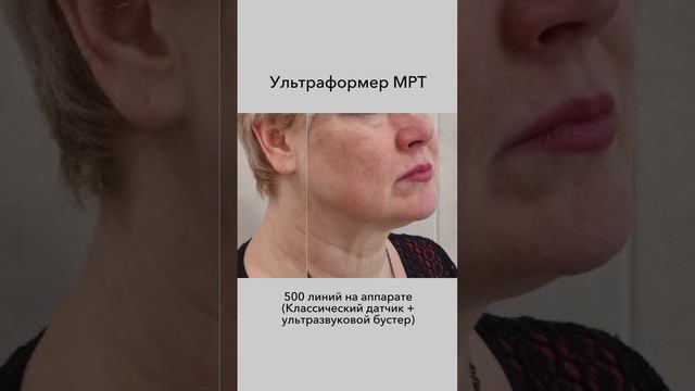 500 линий на аппарате Ultraformer MPT