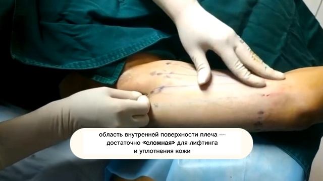 МедЛайн Нитевой лифтинг лица смотреть онлайн