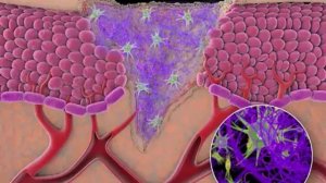 Генгигель - процесс заживления раны.