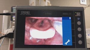 Парадоксальное движение голосовых складок