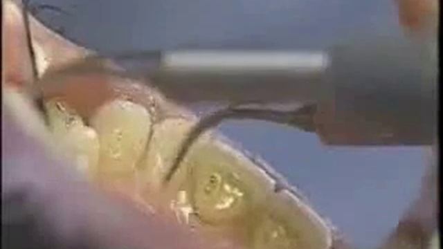 Чистка зубов смотреть онлайн