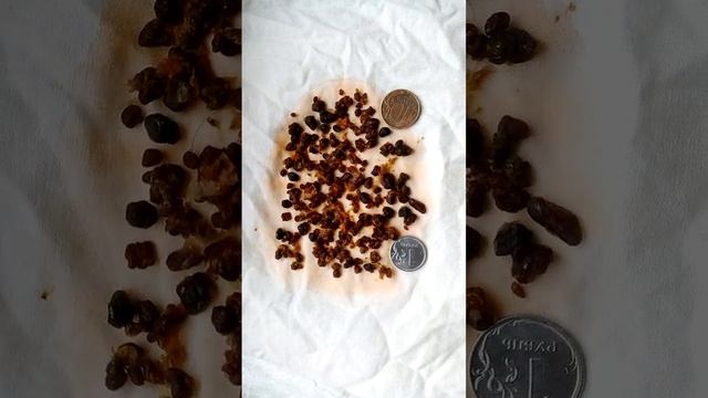 2 я очистка от камней из желчного пузыря, печени, поджел.  железы смотреть онлайн