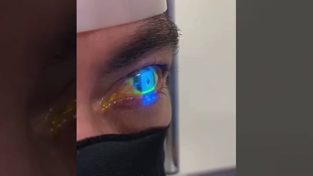 Флуоресценциновый тест для глаз смотреть онлайн