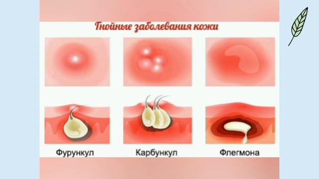 Карбункул