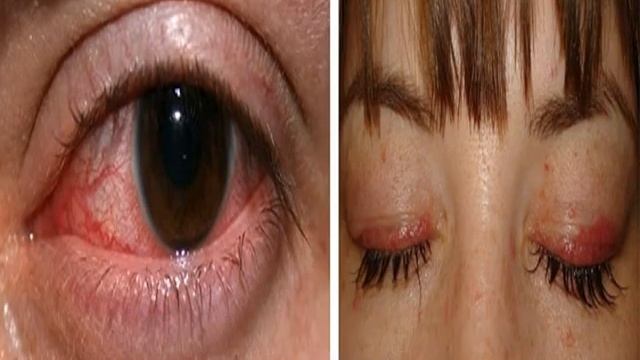 Аллергия на нарощенные ресницы смотреть онлайн