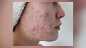 НЕ ДАВИ ПРЫЩИ! ПОЧЕМУ ЗАПРЕЩЕНО ДАВИТЬ ПРЫЩИ НА ЛИЦЕ?