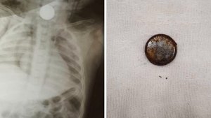 Что будет, если проглотить батарейку.Чем опасна батарейка.здоровьемедицинаболезньврач