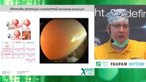 Эндоскопическое удаление эпителиальных образований толстой кишки. К. В. Шишин