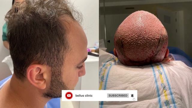 hair transplant in Bellus clinic смотреть онлайн