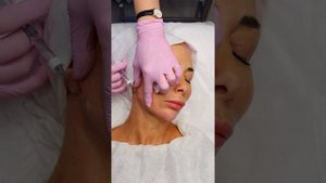 Процедура создания «Профиля Джоли» филлером FEEL DERLI STRONG+