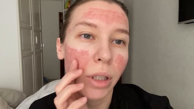 АКНЕ / ПОСТАКНЕ / ЛАЗЕРНАЯ ШЛИФОВКА КОЖИ смотреть онлайн