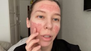 АКНЕ / ПОСТАКНЕ / ЛАЗЕРНАЯ ШЛИФОВКА КОЖИ