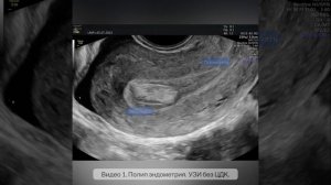 Видео 1.  Полип эндометрия. УЗИ без ЦДК.