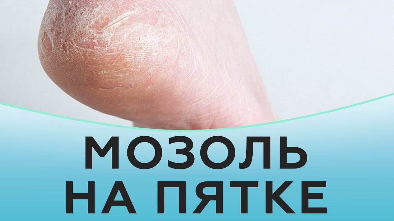 Мозоль на пятке.