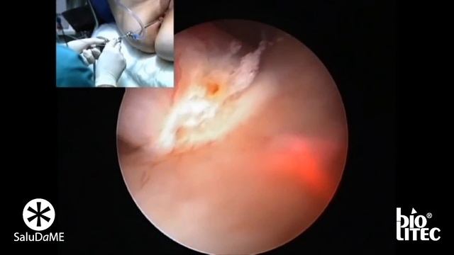Laser Diodo Ginecologia SaluDaME Miomas y polipos смотреть онлайн