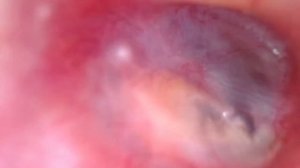 через 5 месяцев после тимпанопластики с оссикулопластикой