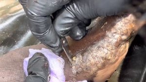 Moses's heavily jiggered left foot (part C) - FULL VIDEO, subscribe to www.riseupsociety.net