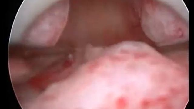 endometrial polip# полип эндометрия