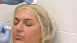 Меди Лайт Ботокс межбровье