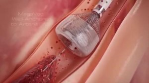 Вены. Удаление варикоза