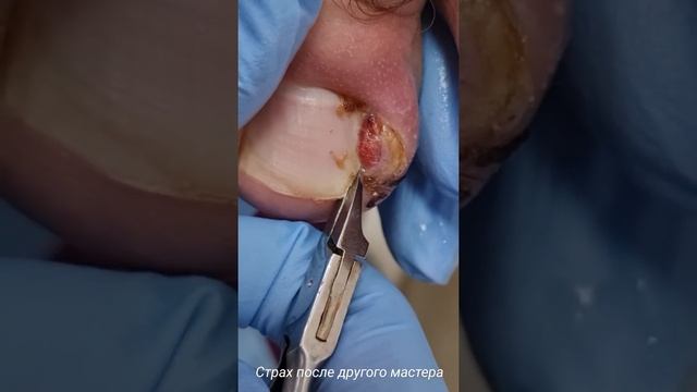 вросший ноготь смотреть онлайн