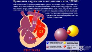 ВПС. Дефект межжелудочковой перегородки.