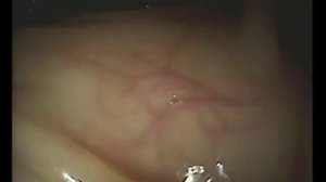 Дивертикулы кишечника Колоноскопия в АС Медикэл