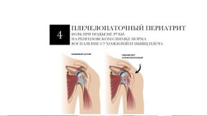 Почему Болит Плечевой Сустав